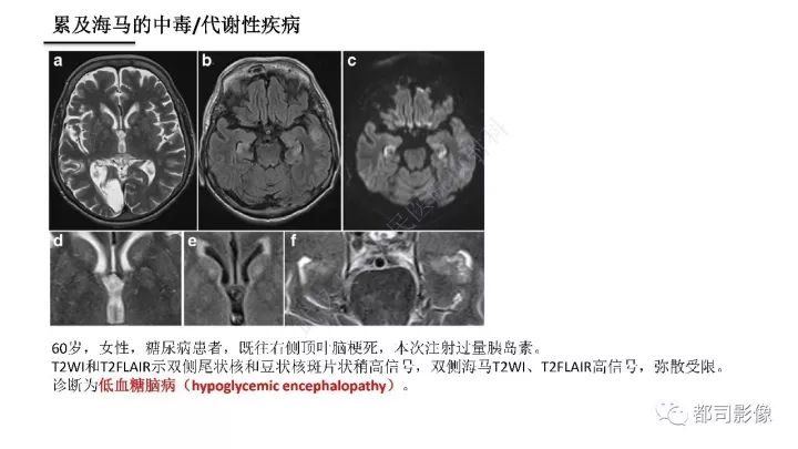 【PPT】海马正常解剖与疾病影像诊断