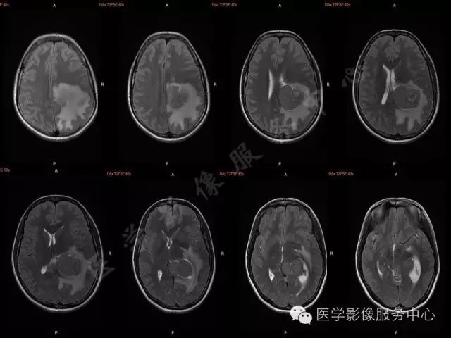 【病例】脑室内脑膜瘤1例MR