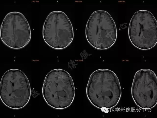 【病例】脑室内脑膜瘤1例MR