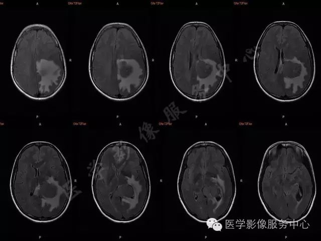 【病例】脑室内脑膜瘤1例MR