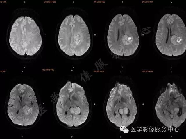 【病例】脑室内脑膜瘤1例MR