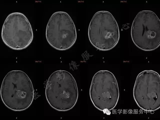 【病例】脑室内脑膜瘤1例MR