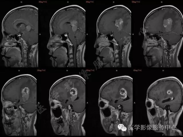 【病例】脑室内脑膜瘤1例MR