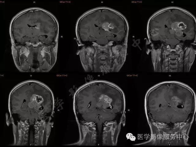 【病例】脑室内脑膜瘤1例MR