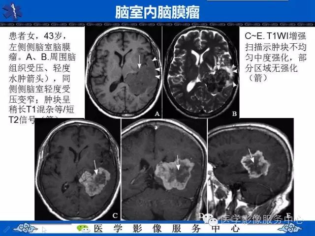 【病例】脑室内脑膜瘤1例MR