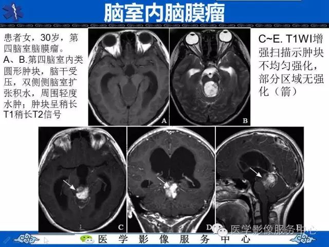 【病例】脑室内脑膜瘤1例MR