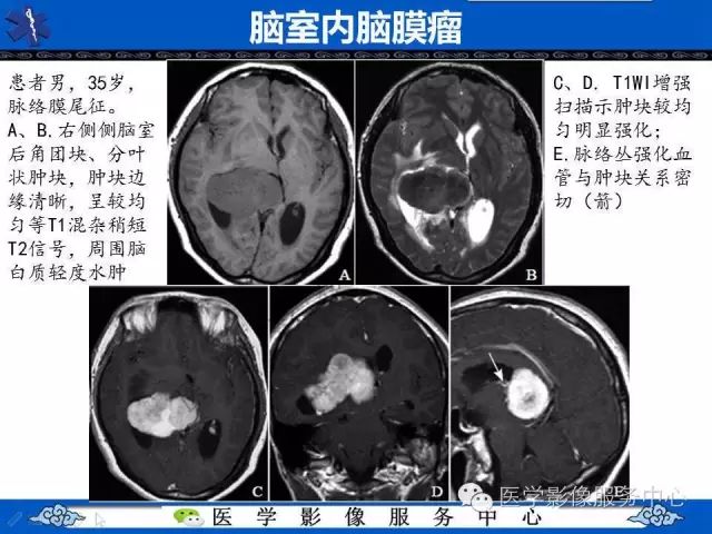 【病例】脑室内脑膜瘤1例MR