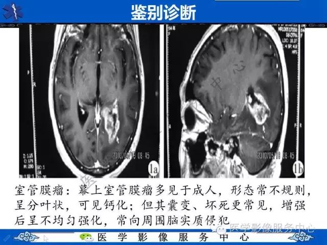 【病例】脑室内脑膜瘤1例MR
