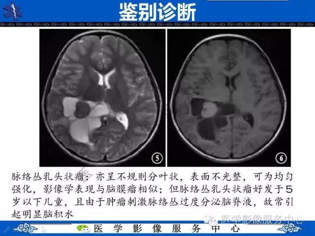 【病例】脑室内脑膜瘤1例MR