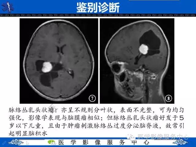 【病例】脑室内脑膜瘤1例MR