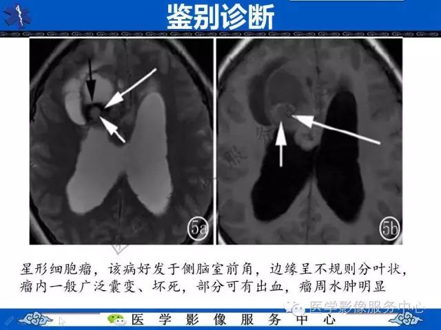【病例】脑室内脑膜瘤1例MR