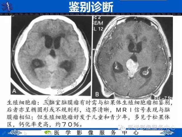 【病例】脑室内脑膜瘤1例MR