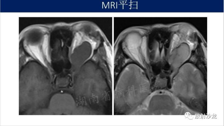【病例】眼眶脑膜瘤1例MR