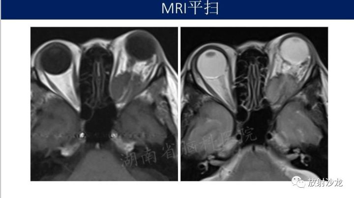 【病例】眼眶脑膜瘤1例MR