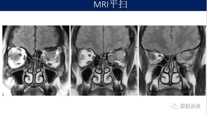 【病例】眼眶脑膜瘤1例MR