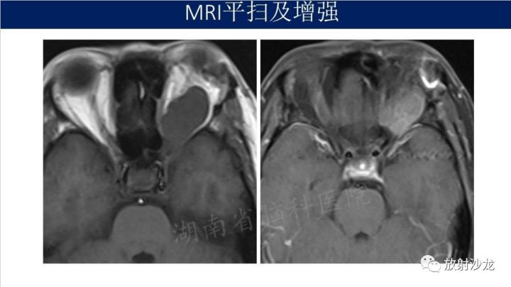 【病例】眼眶脑膜瘤1例MR