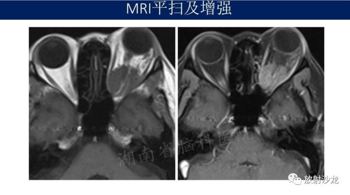 【病例】眼眶脑膜瘤1例MR