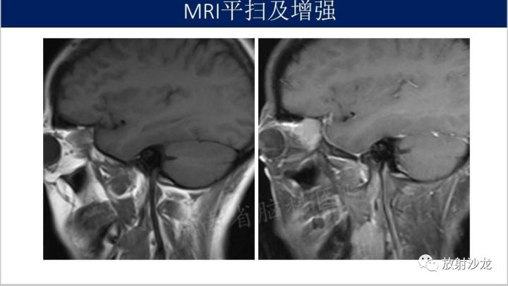 【病例】眼眶脑膜瘤1例MR