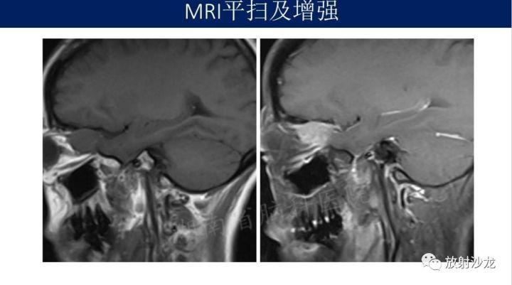 【病例】眼眶脑膜瘤1例MR
