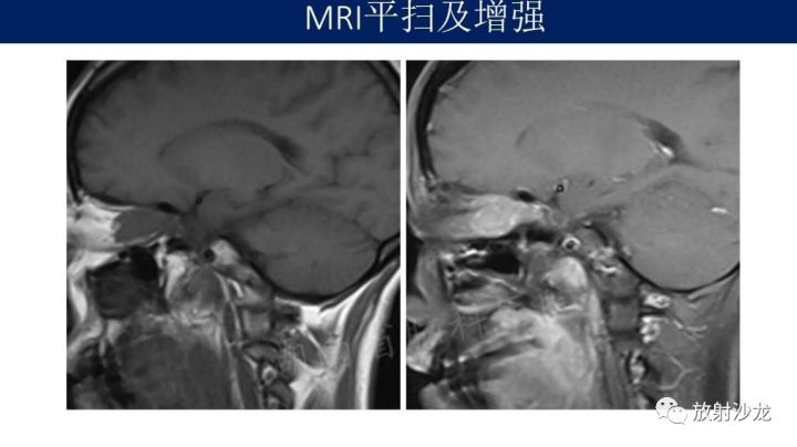 【病例】眼眶脑膜瘤1例MR
