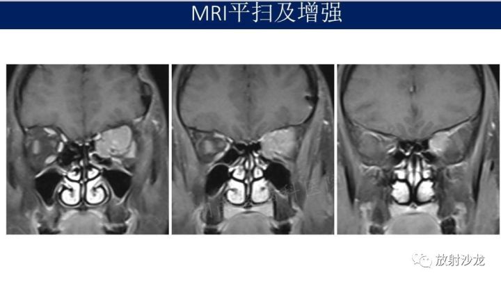 【病例】眼眶脑膜瘤1例MR