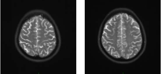 病毒性脑炎的MRI 病毒性脑炎的MRI
