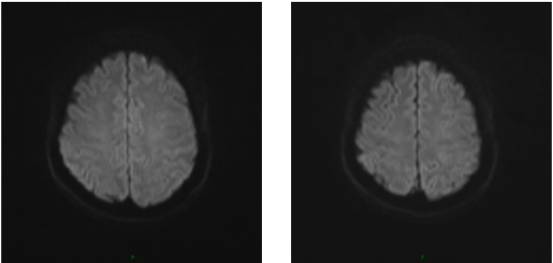 病毒性脑炎的MRI 病毒性脑炎的MRI