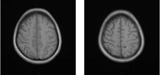 病毒性脑炎的MRI 病毒性脑炎的MRI