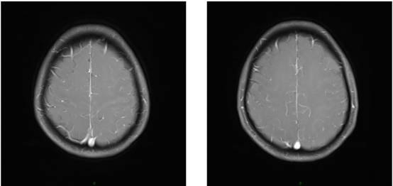 病毒性脑炎的MRI 病毒性脑炎的MRI