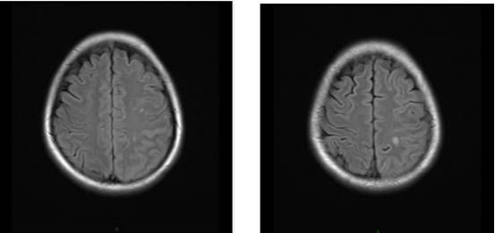 病毒性脑炎的MRI