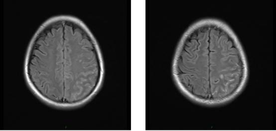 病毒性脑炎的MRI 病毒性脑炎的MRI