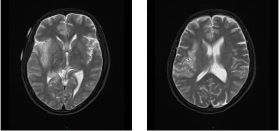 病毒性脑炎的MRI 病毒性脑炎的MRI