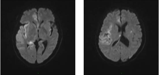 病毒性脑炎的MRI 病毒性脑炎的MRI