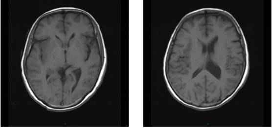 病毒性脑炎的MRI 病毒性脑炎的MRI