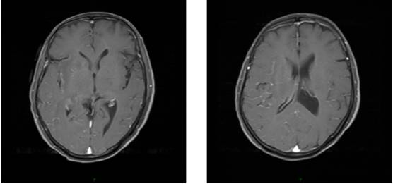 病毒性脑炎的MRI 病毒性脑炎的MRI