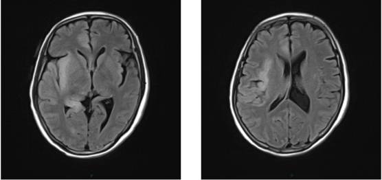 病毒性脑炎的MRI 病毒性脑炎的MRI