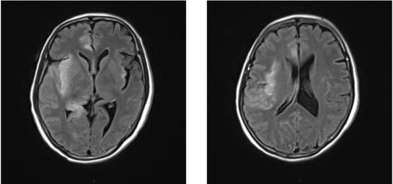病毒性脑炎的MRI 病毒性脑炎的MRI
