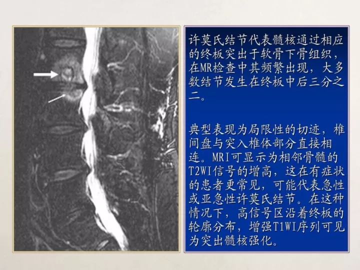 【PPT】终板退变