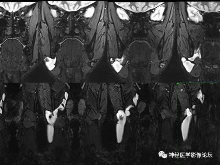 【病例】颈部淋巴管瘤VS神经鞘瘤