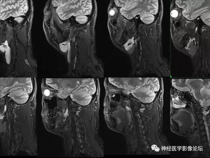 【病例】颈部淋巴管瘤VS神经鞘瘤