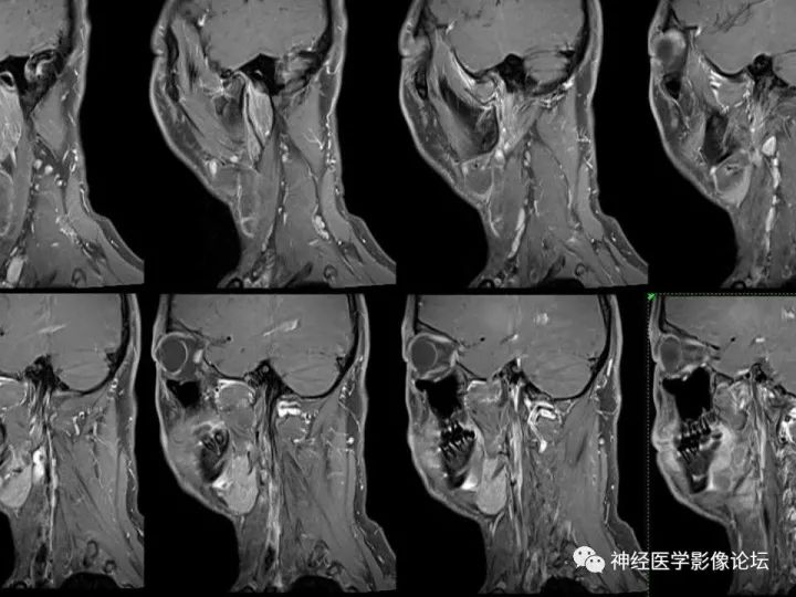 【病例】颈部淋巴管瘤VS神经鞘瘤