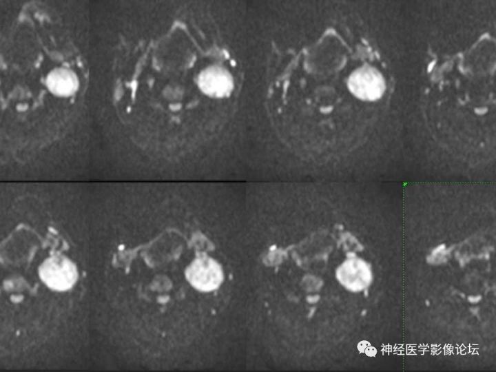 【病例】颈部淋巴管瘤VS神经鞘瘤