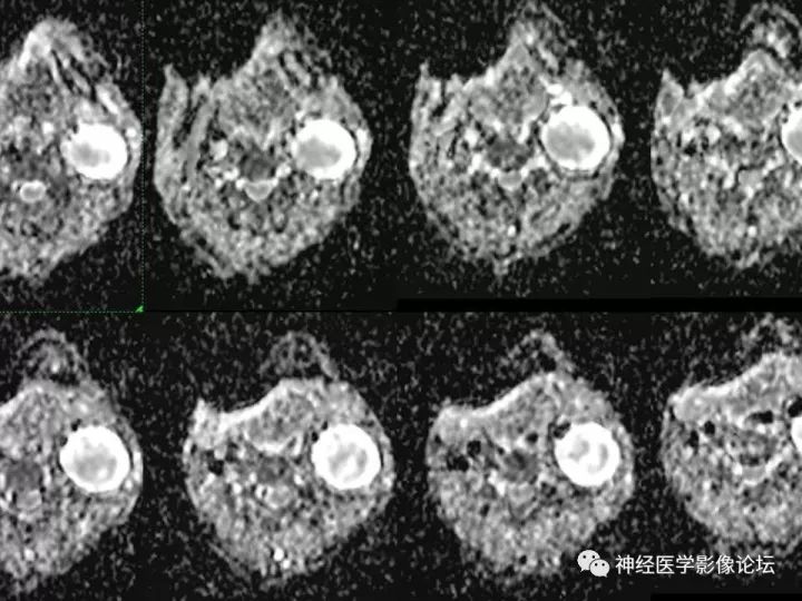 【病例】颈部淋巴管瘤VS神经鞘瘤