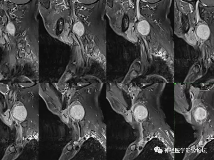 【病例】颈部淋巴管瘤VS神经鞘瘤