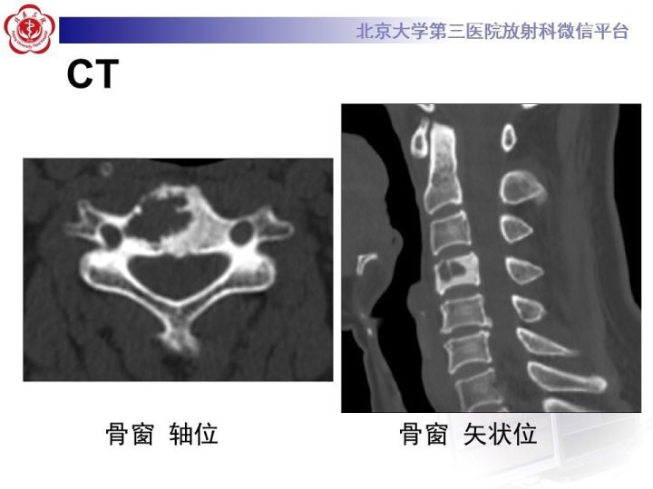 【病例】颈椎血管瘤1例CT及MR