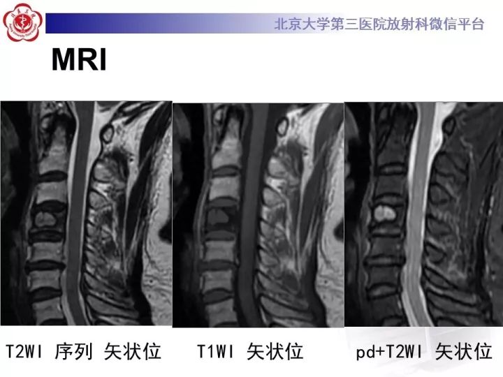 【病例】颈椎血管瘤1例CT及MR