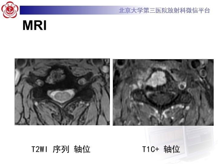 【病例】颈椎血管瘤1例CT及MR