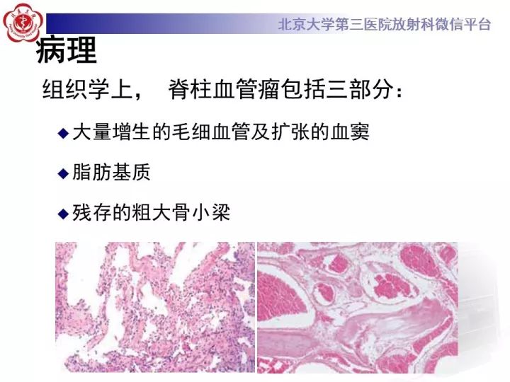 【病例】颈椎血管瘤1例CT及MR