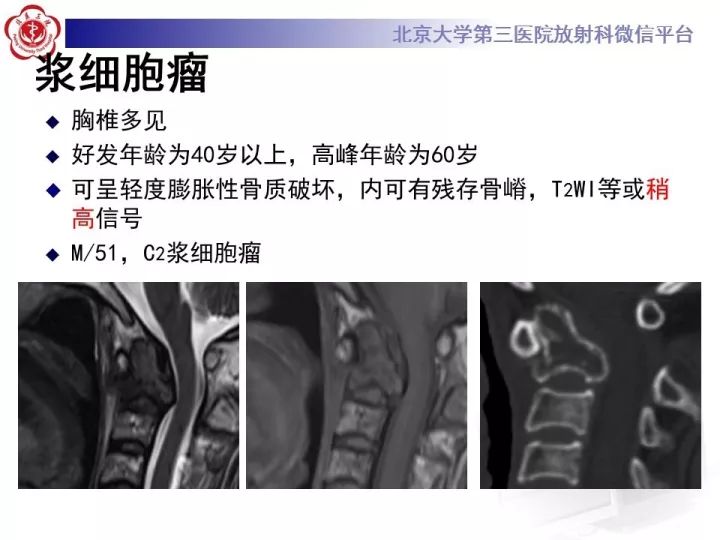 【病例】颈椎血管瘤1例CT及MR