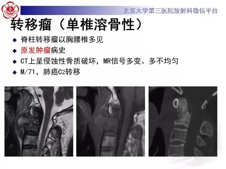 【病例】颈椎血管瘤1例CT及MR
